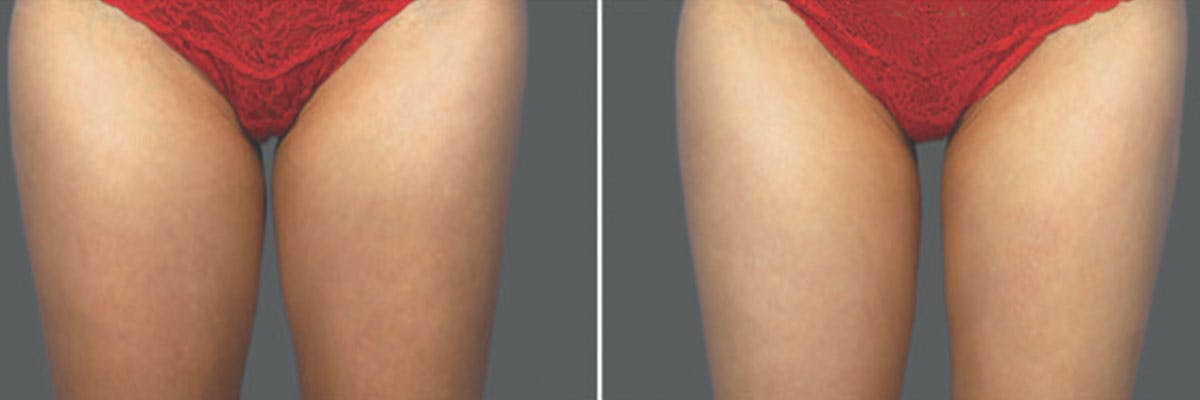 Before and after photos of coolsculpting elite patient