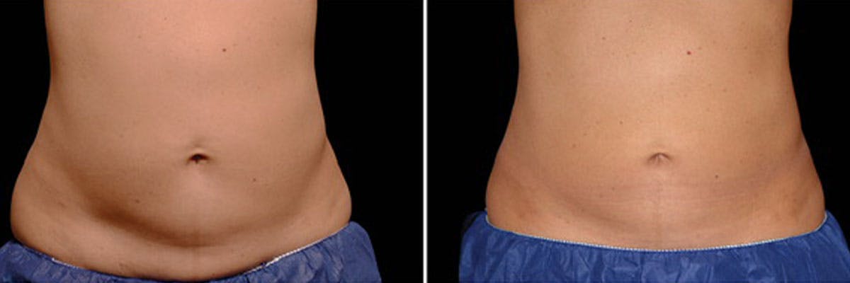 Before and after photos of coolsculpting elite patient