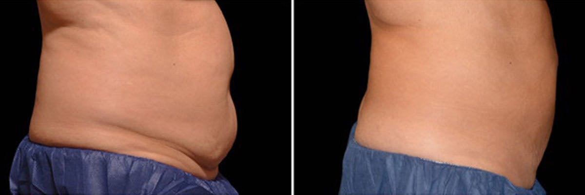 Before and after photos of coolsculpting elite patient