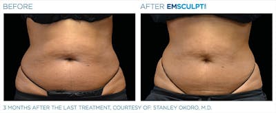 before & after patient results of ENSCULPT NEO on stomach in Dr Phillips, FL