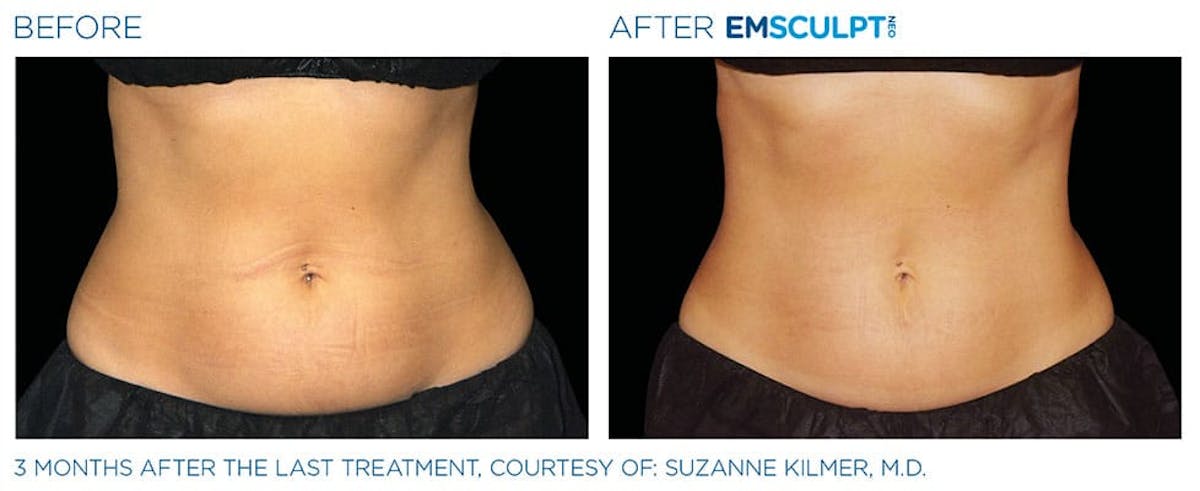 before & after patient results of ENSCULPT NEO on abs in Dr Phillips, FL