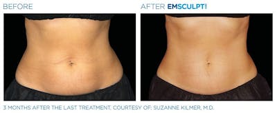 before & after patient results of ENSCULPT NEO on abs in Dr Phillips, FL