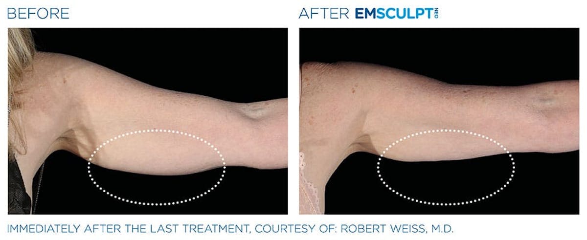 before & after patient results of ENSCULPT NEO on arms in Dr Phillips, FL