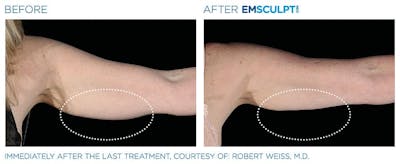 before & after patient results of ENSCULPT NEO on arms in Dr Phillips, FL