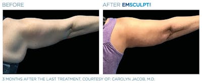 before & after patient results of ENSCULPT NEO on arms in Dr Phillips, FL