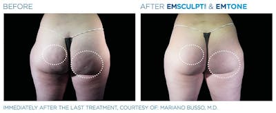 before & after patient results of ENSCULPT NEO in Dr Phillips, FL