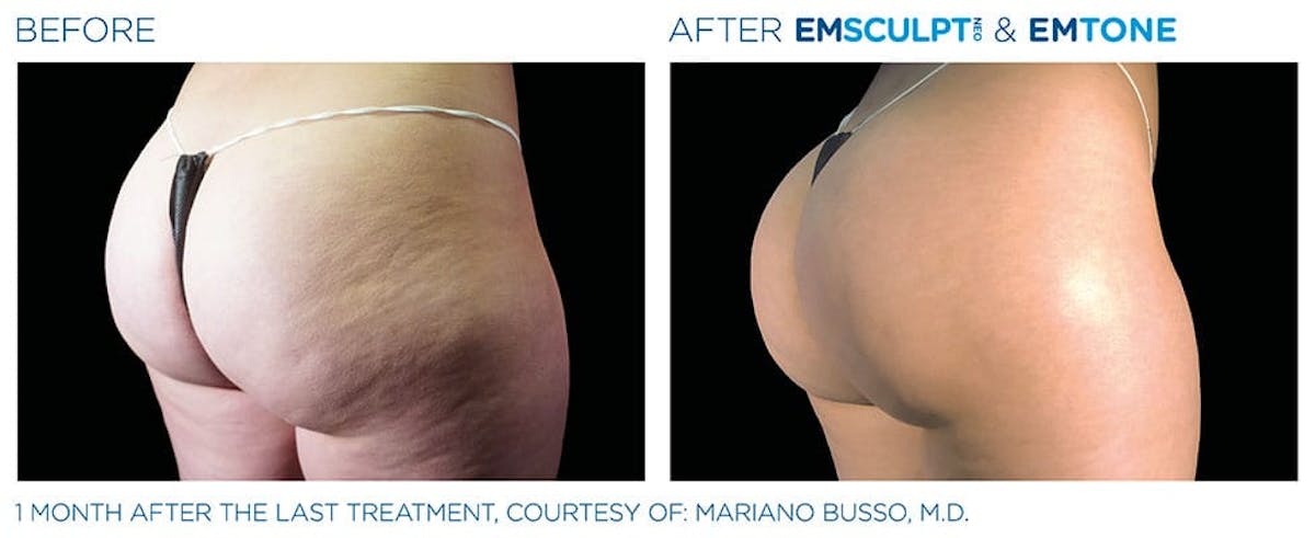 before & after patient results of ENSCULPT NEO in Dr Phillips, FL