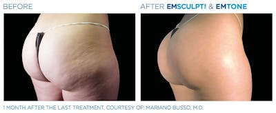 before & after patient results of ENSCULPT NEO in Dr Phillips, FL