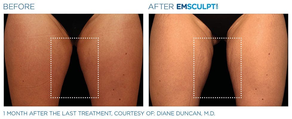 before & after patient results of ENSCULPT NEO in Dr Phillips, FL