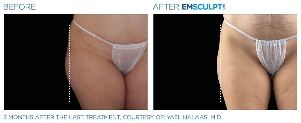 before & after patient results of ENSCULPT NEO in Dr Phillips, FL