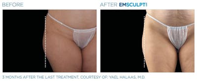 before & after patient results of ENSCULPT NEO in Dr Phillips, FL