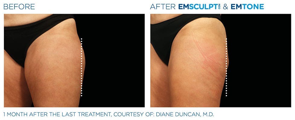 before and after EMSCULPT NEO patient results in Lake Nona, FL