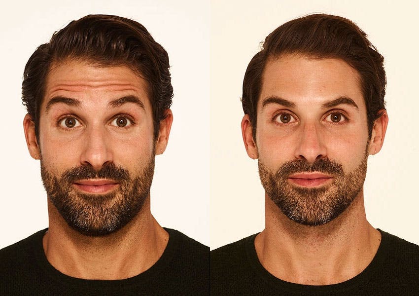 before and after results of Botox of man in Virginia Beach, VA