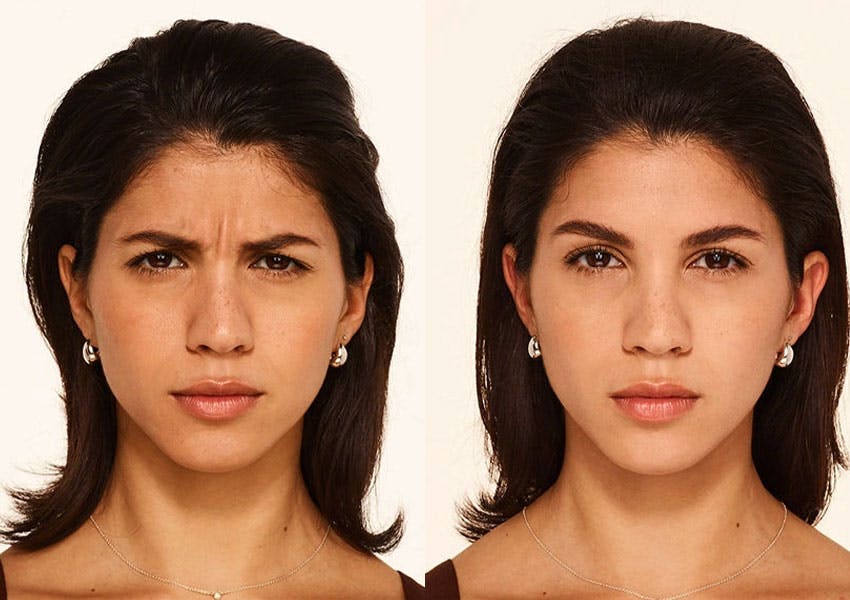 Virginia Beach Botox patient's before and after results