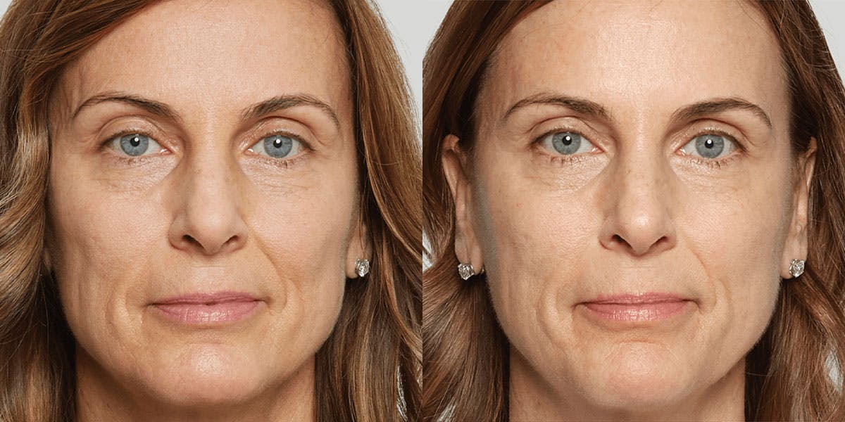 St. Petersburg Sculptra patient before and after results