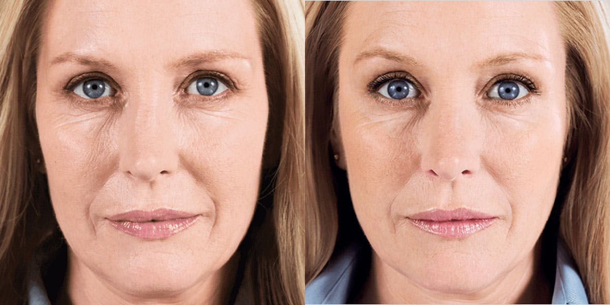 patient results from Sculptra treatment in St. Petersburg