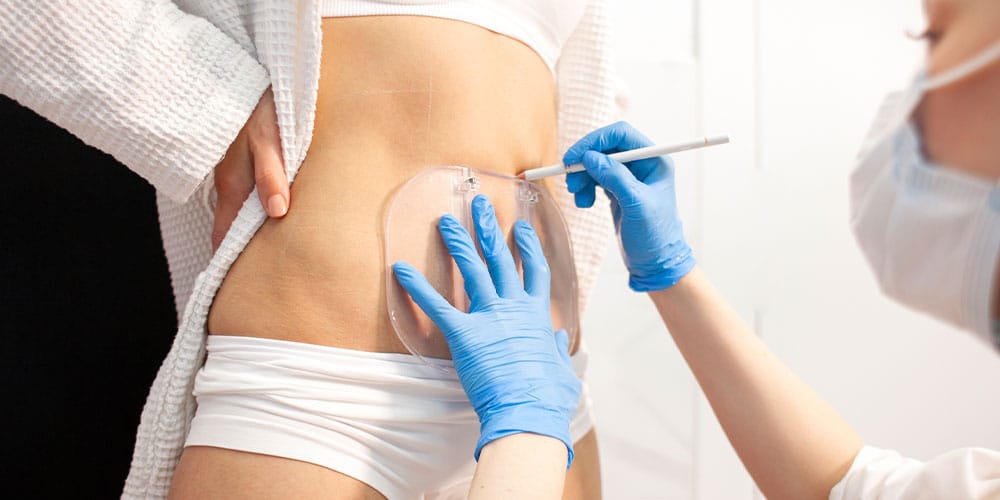 woman during her coolsculpting treatment