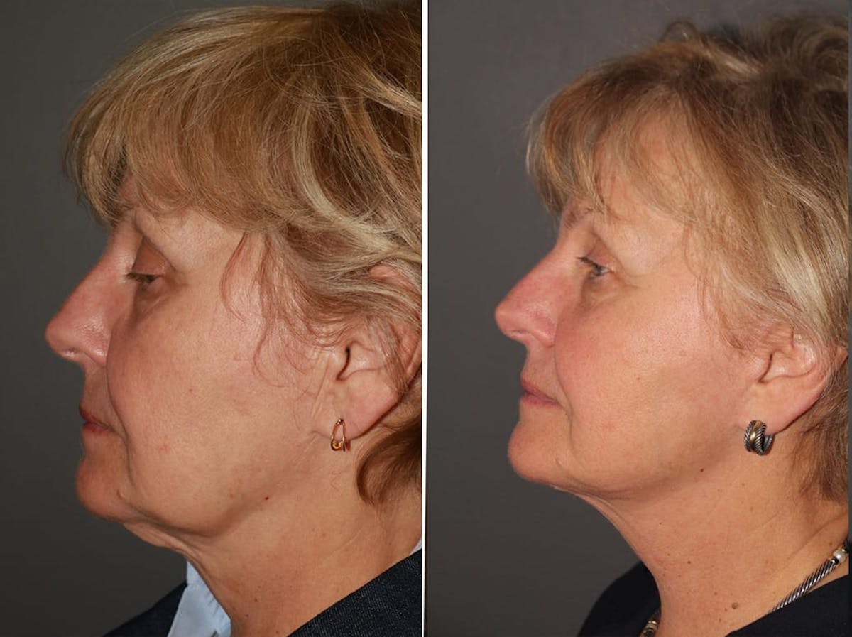 Facelift Before & After Gallery - Patient 252310 - Image 1