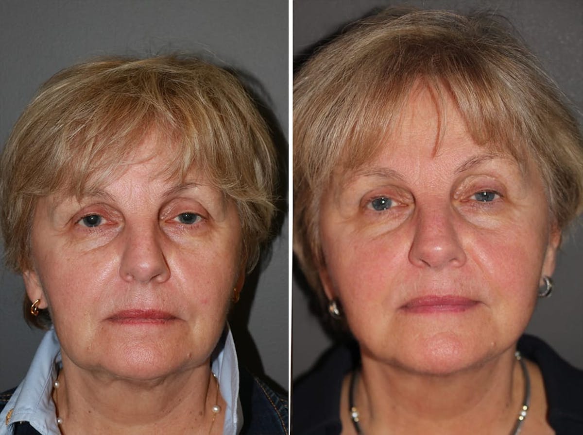 Facelift Before & After Gallery - Patient 252310 - Image 2