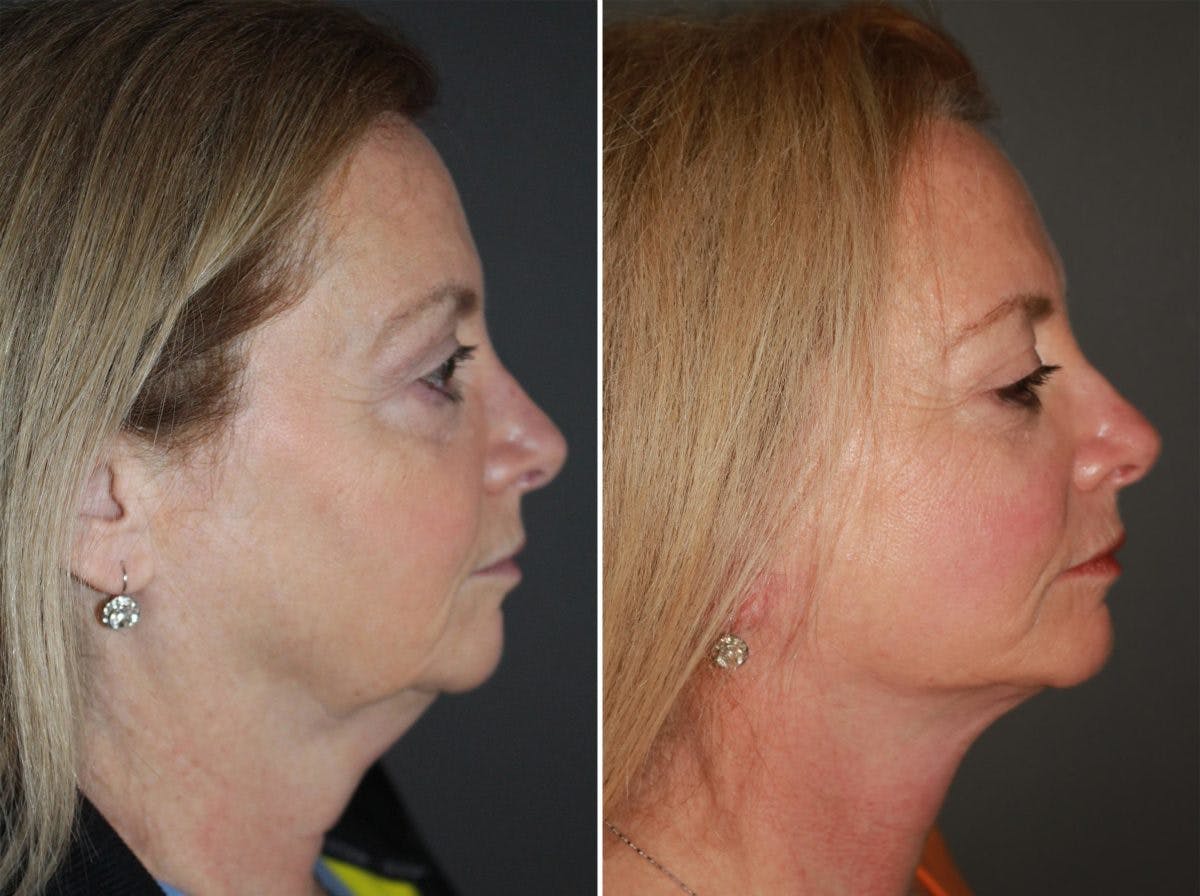 Facelift Before & After Gallery - Patient 216397 - Image 2