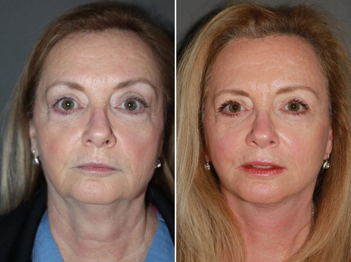 Facelift Before & After Gallery - Patient 216397 - Image 3