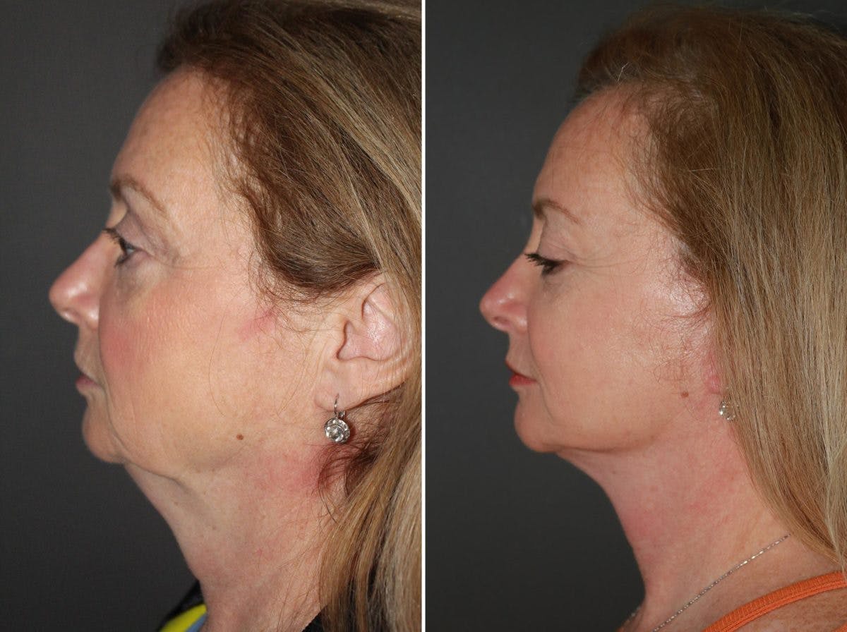 Facelift Before & After Gallery - Patient 216397 - Image 1