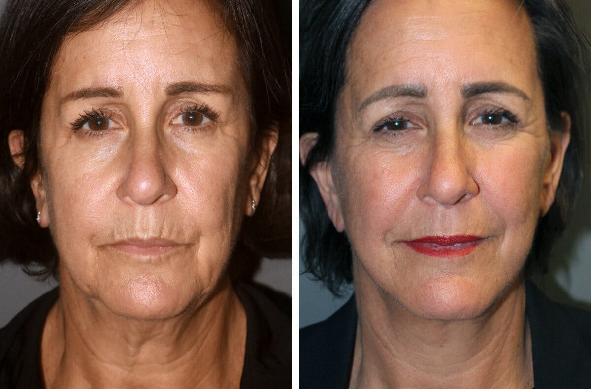 Facelift Before & After Gallery - Patient 417307 - Image 2