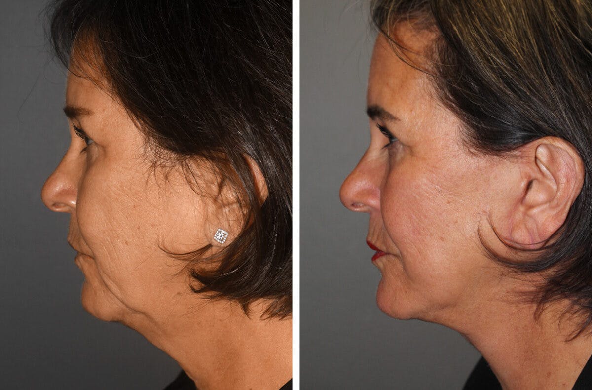 Facelift Before & After Gallery - Patient 417307 - Image 1