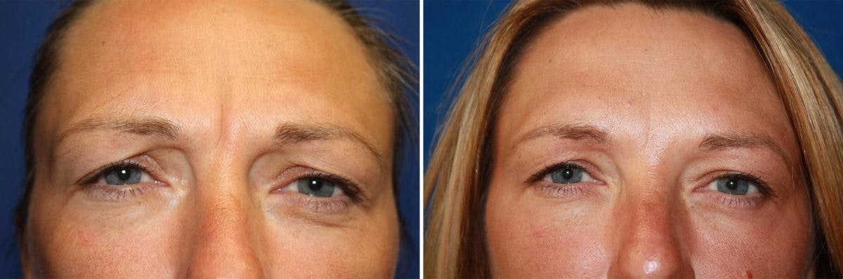 Botox Before & After Gallery - Patient 222144 - Image 1