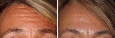 Botox Before & After Gallery - Patient 415117 - Image 1