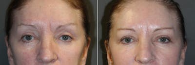 Botox Before & After Gallery - Patient 161430 - Image 1