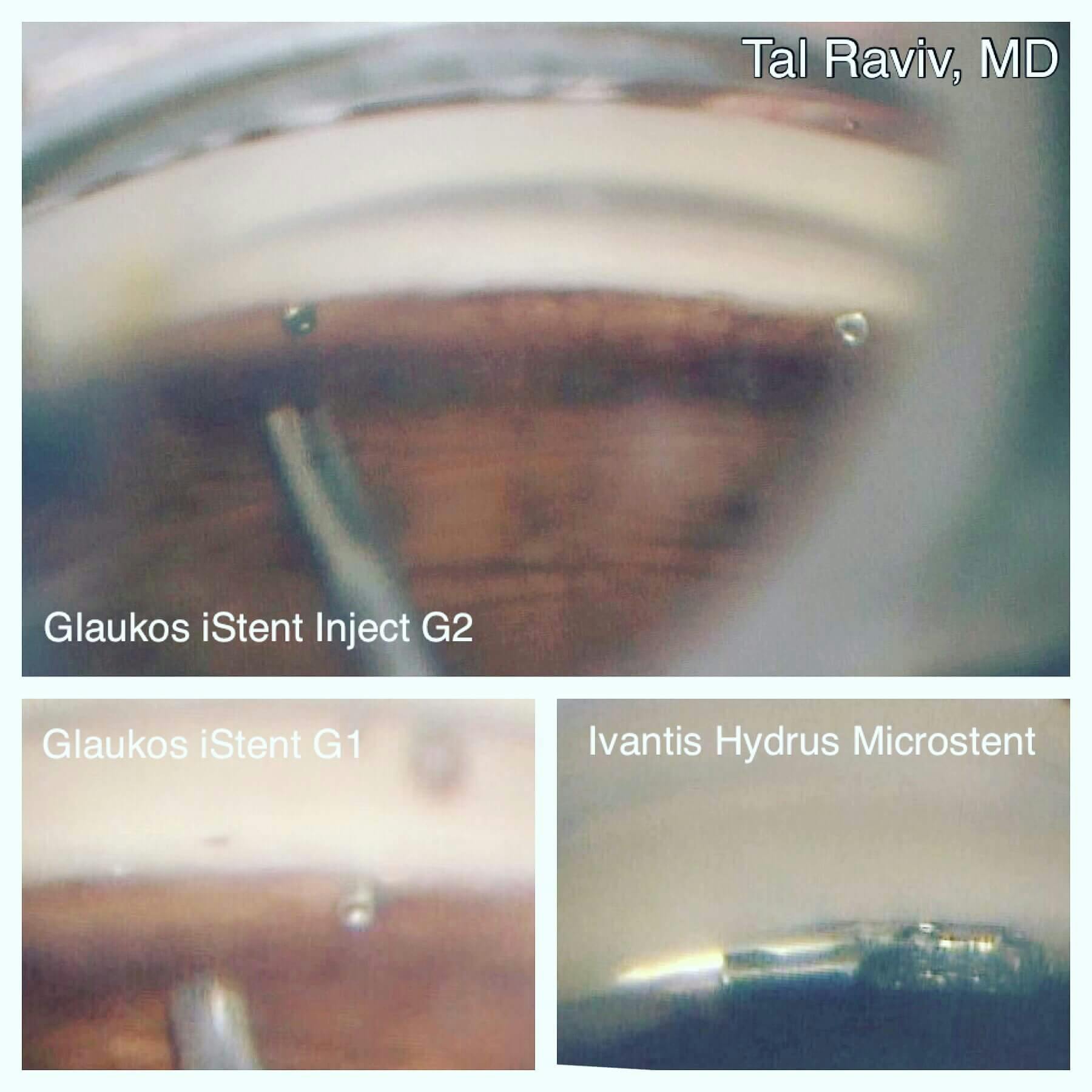 close up of a device going into an eye