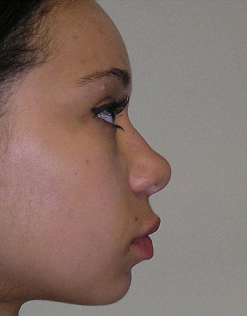 Ethnic Rhinoplasty Before & After Gallery - Patient 281560 - Image 3