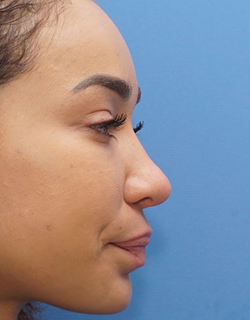 Ethnic Rhinoplasty Before & After Gallery - Patient 281560 - Image 2