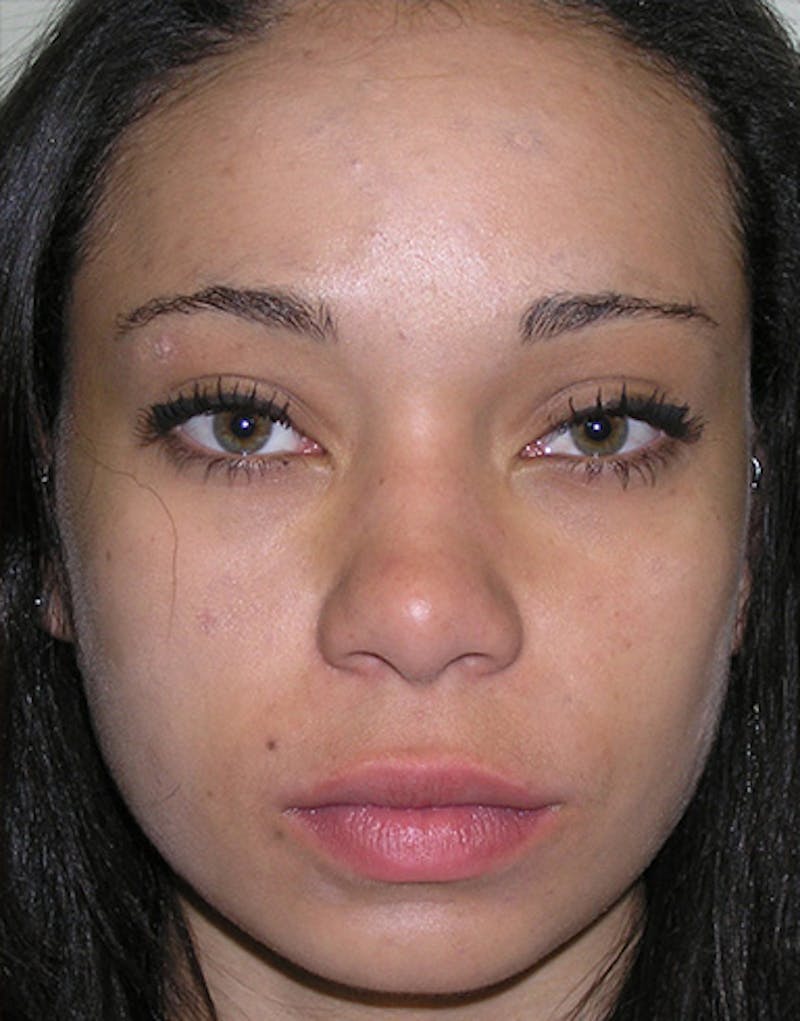 Ethnic Rhinoplasty Before & After Gallery - Patient 281560 - Image 3