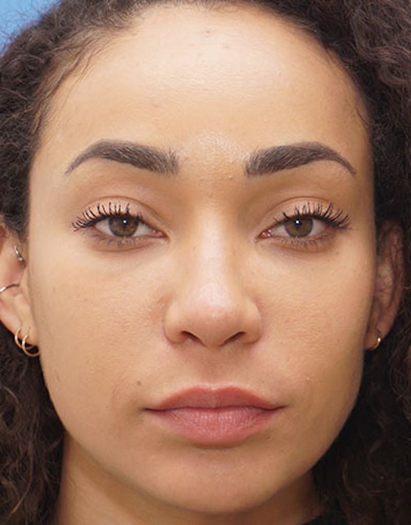 Ethnic Rhinoplasty Before & After Gallery - Patient 281560 - Image 2