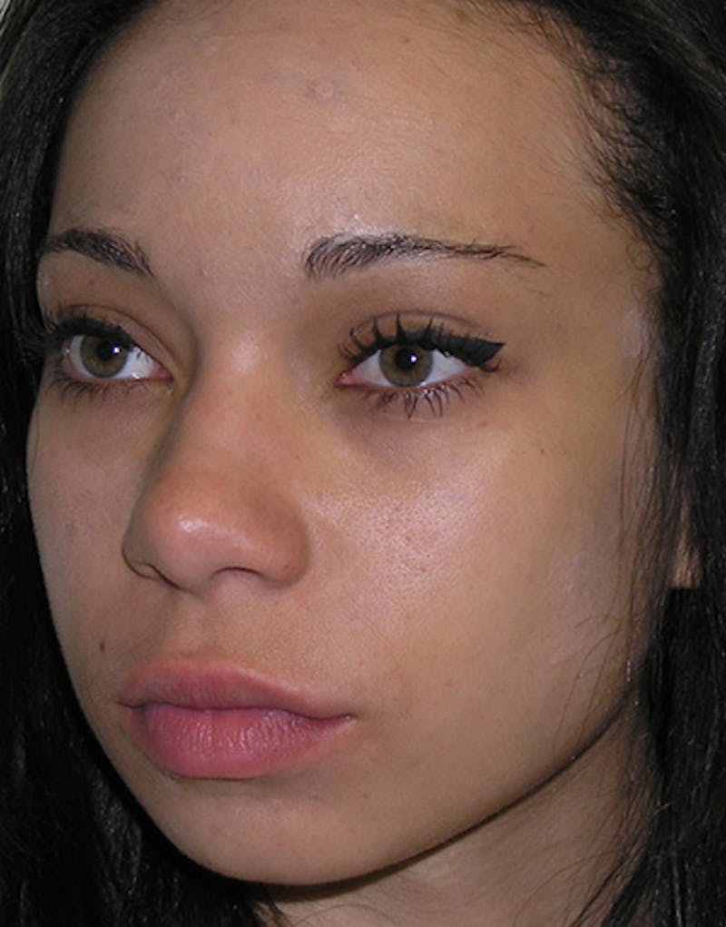 Ethnic Rhinoplasty Before & After Gallery - Patient 281560 - Image 5
