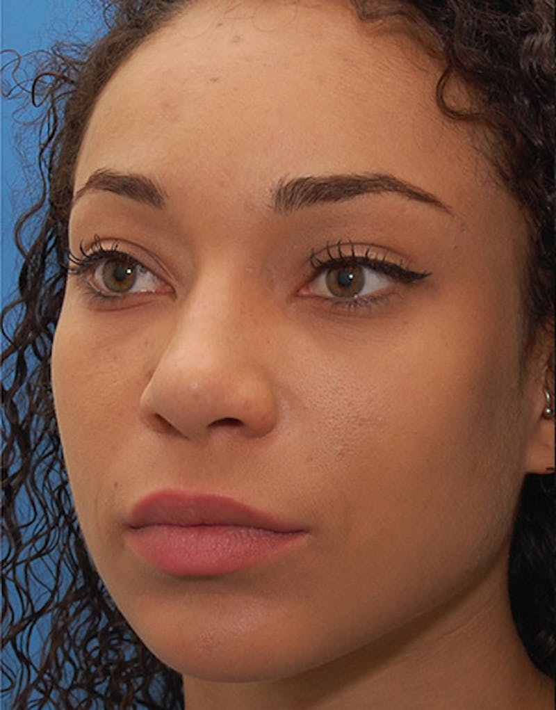 Ethnic Rhinoplasty Before & After Gallery - Patient 281560 - Image 6