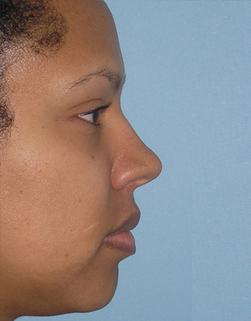 Ethnic Rhinoplasty Before & After Gallery - Patient 635528 - Image 1