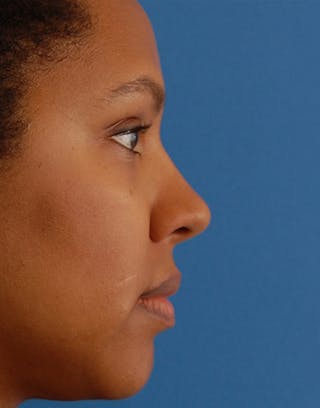 Rhinoplasty Before & After Gallery - Patient 367590 - Image 2