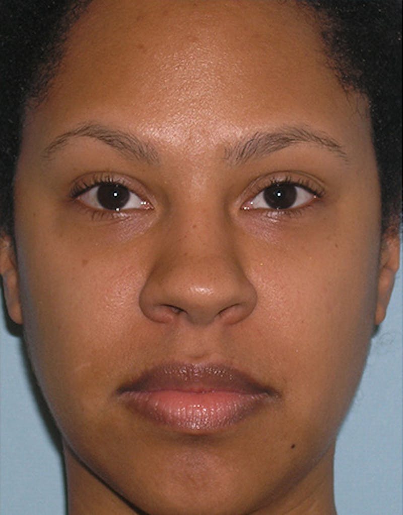 Rhinoplasty  Before & After Gallery - Patient 367590 - Image 3