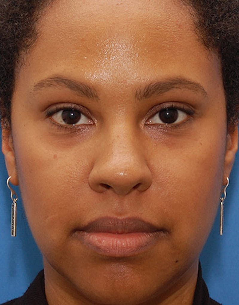 Ethnic Rhinoplasty Before & After Gallery - Patient 635528 - Image 4