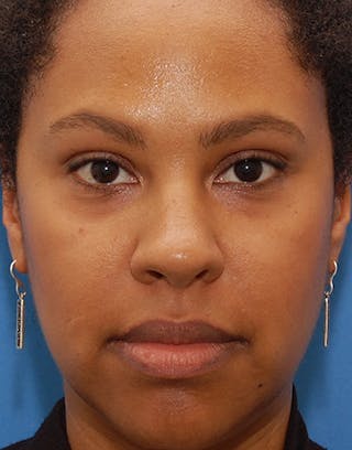 Rhinoplasty Before & After Gallery - Patient 367590 - Image 4
