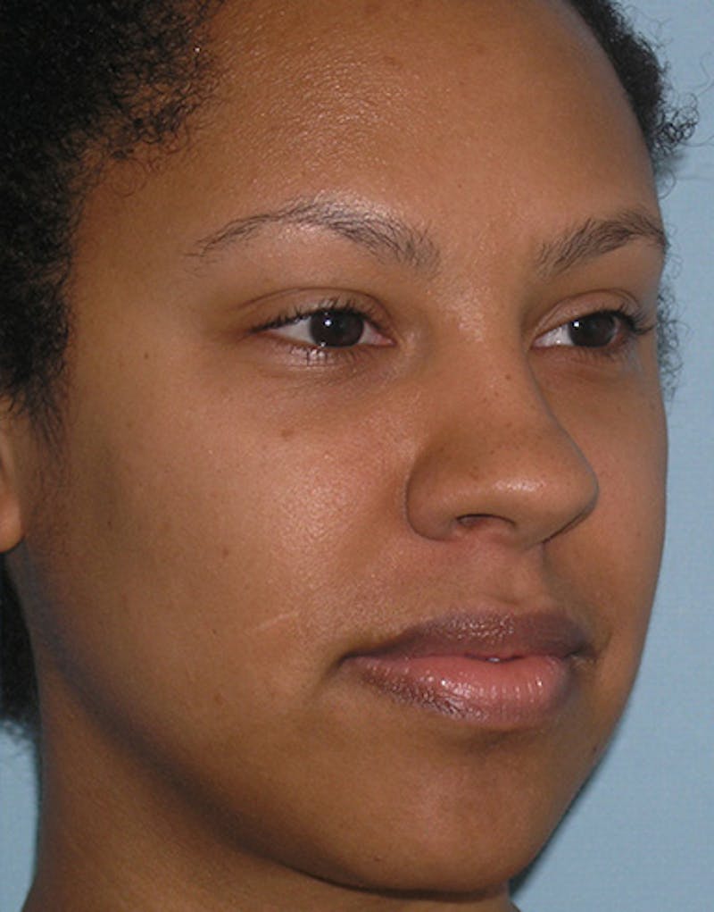 Rhinoplasty  Before & After Gallery - Patient 367590 - Image 5