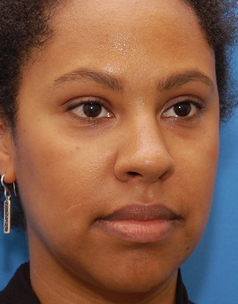 Rhinoplasty  Before & After Gallery - Patient 367590 - Image 6