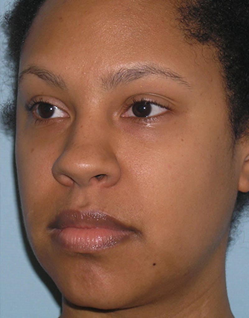 Rhinoplasty  Before & After Gallery - Patient 367590 - Image 7