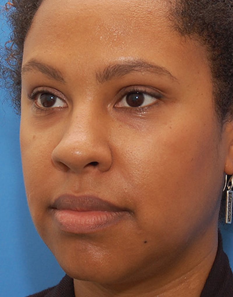 Rhinoplasty  Before & After Gallery - Patient 367590 - Image 8