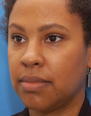 Rhinoplasty Before & After Gallery - Patient 367590 - Image 8