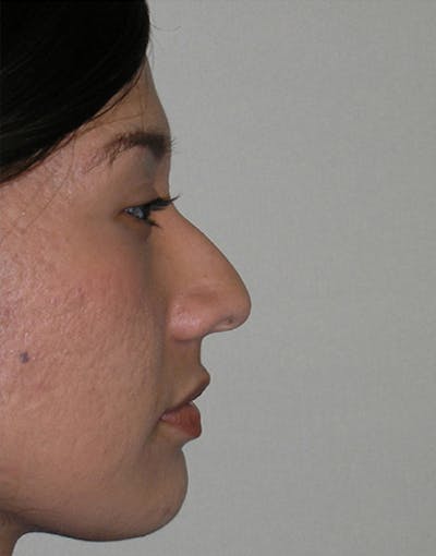Rhinoplasty Before & After Gallery - Patient 412234 - Image 1