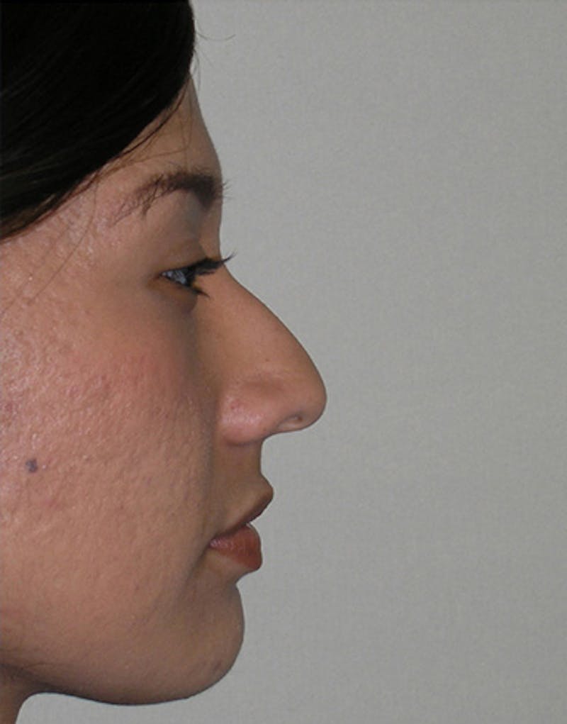 Ethnic Rhinoplasty Before & After Gallery - Patient 244978 - Image 1